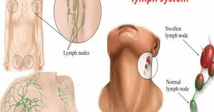 Multiple lymph nodes in neck. Sign Symptoms Of Neck Cancer In Lymph Node