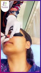 Rediscover Smooth and Spotless Skin: Wart Removal Treatment at Skin Clinic  Vasundhara (Dr. Megha Modi)., #WartRemoval #SkinClinic #SmoothSkin  #SpotlessSkin #SkinCare #Dermatology #SkinHealth