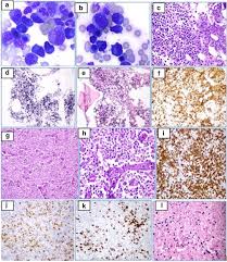 Sergiu pasca1, ancuta jurj2 *, daniela matei3,4. Florid Plasmacytosis In Angioimmunoblastic T Cell Lymphoma A Diagnostic Conundrum Springerlink