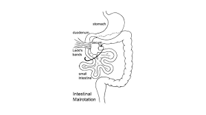 Image result for Intestinal Malrotation