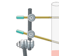 Modular external fixation