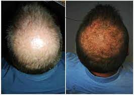 Apple cider vinegar and baking soda for hair loss baking soda along with acv removes toxins from your hair and fosters hair growth and prevents hair loss. Apple Cider Vinegar For Hair Zevect Com