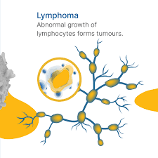Image result for Hematologic Cancer