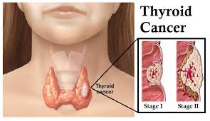 Symptoms of thyroid problems in men Thyroid Cancer Lust With Life Health Tips Beauty Hacks Medicine Medical Question Bank Mbbs Md Questions
