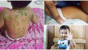 Air kelapa dianggap ubat mujarab untuk proses. Chicken Pox Kering Dalam 7 Hari Ibu Ini Kongsi Tips Cara Penjagaannya