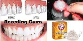6 Natural Ways To Stop And Heal Receding Gums Before It S Too Late Gum Disease Remedies Gum Health Gum Disease Treatment