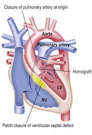 Truncus Arteriosus Communis Tac Dhzb