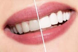 Maybe you would like to learn more about one of these? Ø²ÙÙÙØ¶ÙÙ Ø²ÙÙ On Twitter Pagi Ni Nak Sharing Pasal Teeth Whitening Atau Putihkan Gigi Di Klinik Berdaftar Aku Tahu Ramai Betul Berminat Dan Teringin Nak Buat Whitening Ni Aku Share Sedikit Benda