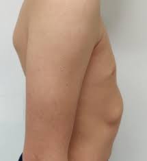 Take your top arm towards the ceiling, so your hand is in line with your shoulders. Rib Flaring Pectus Brace