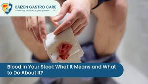 Image result for Blood in stool