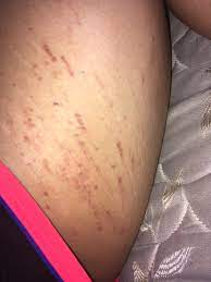 Bruised Looking Stretch Marks Penny Arcade