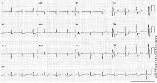 O ecg inicial no infartos com onda q mostra supradesnivelamento do ponto j e do segmento st. Infarto Do Miocardio Sem Supradesnivelamento Do Segmento St Sintomas Diagnostico E Tratamento Bmj Best Practice