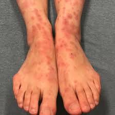 Image result for Erythema Multiforme