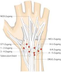 The tfcc is a structure running from the medial border of the radius to the styloid area of the ulna and with a distal volar expansion to the carpus. Handgelenksarthroskopie Pdf Free Download