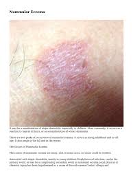 Check spelling or type a new query. Nummular Eczema Dermatitis Dermatology