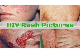 Image result for skin rash acute hiv infection