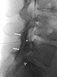 Learn lumbar spine anatomy so that you can better understand your low back pain. Fluoroscopically Guided Epidural Injections Of The Cervical And Lumbar Spine Radiographics