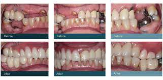 Flexible Dentures In Glasgow Tiwari Watson Dental Care