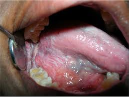 Image result for lichen planus on tongue)