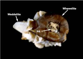Calcium Oxalate Stone In A Hypercalciuric Patient The Stone Is Made Of Download Scientific Diagram