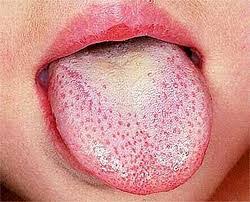 Image result for Scarlet Fever