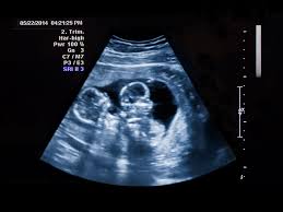 Pregnant With Twins About Twin Pregnancy Raising Children Network