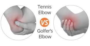 There are other symptoms, but these are the most common ones that you can watch out for. Tennis Elbow And Golfer S Elbow What S The Difference Oh My Arthritis