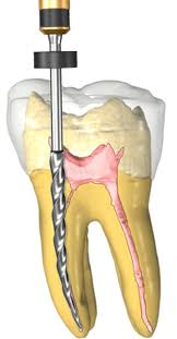 Image result for rct image