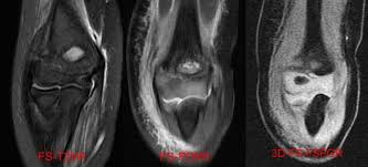 Image result for Lateral Condyle Fracture
