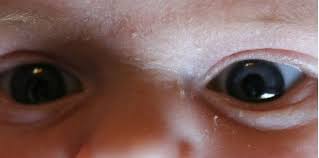 Saya kuatir melihat mata sebelah bayi saya sering sekali berair dan mengeluarkan kotoran pada mata nya. Bayi Sakit Mata 3 Cara Mengatasi Masalah Tahi Mata Pada Bayi Theasianparent Malaysia