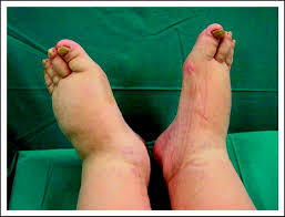 Image result for Yellow nail syndrome feet