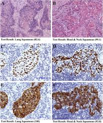 In other cases, drug therapy, chemotherapy or radiation, or a combination of these treatments, may also be used. Distinction Of Head Neck Squamous Cell Carcinoma Hnscc And Lung Download Scientific Diagram