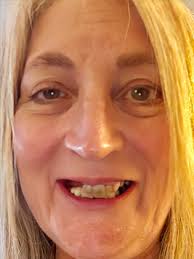 Dental Implants Orlando, FL