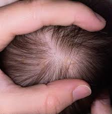 Image result for white scabs on the head in children
