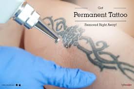 This is the most common and popular way to remove a permanent tattoo. Get Permanent Tattoo Removed Right Away By Dr Shruti Lybrate