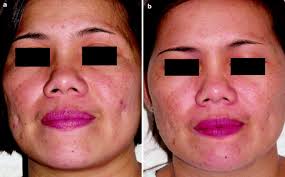 Melasma