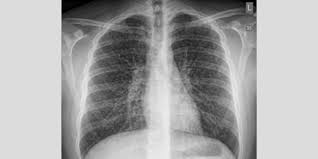 Popcorn Lungs From Vaping Pictures