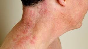 The most commonly reported is the strep a bacteria or streptococcus pyogenes that could also cause strep throat. All About Cellulitis Causes Symptoms Treatment And More Everyday Health