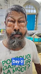 Thoracic Surgery Diary Surgical emphysema: Terrifying or Consciousness  Surgical emphysema is accumulation of air beneath skin. Air escaping from  pleura entering into skin. Pleura breaches from trauma or ruptured bulla or  pneumothorax