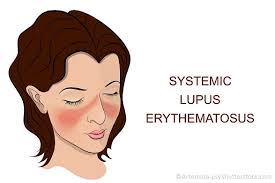 Muscle and joint symptoms usually involve the arms and legs, but not the spine. Fatigue In Patients With Lupus Is Real