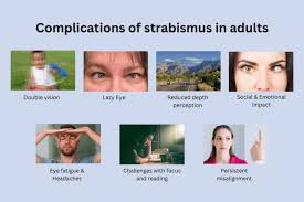 Image result for Strabismus