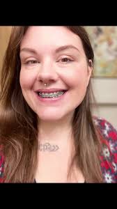 😜 been waiting 3 years for this #fyp #foryou #braces #adultbraces  #orthodontist #beforeandafter #beforeandafterbraces