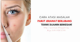 Siapa ada dilema macam ni?? 4 Cara Atasi Masalah Parut Jerawat Berlubang Teknik Dijamin Berkesan Amizah Azid