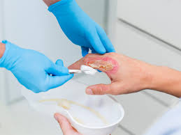 Expert Q A On Burn Care How Can You Help Manage Patient Reported Pain And Anxiety Medline