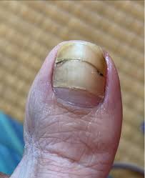 Image result for Beau lines feet