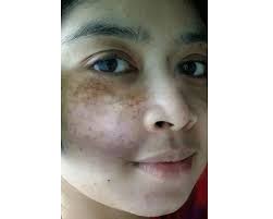 Hilangkan jerawat badan dengan mary kay scrub! Cara Hilangkan Jeragat Di Muka Ayue Idris