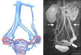 Pelvic Congestion Syndrome Minimally Invasive Vascular