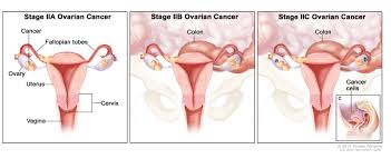 In this form of cancer, certain cells in the ovary become abnormal and multiply uncontrollably to form a tumor. Ovarian Epithelial Cancer Treatment Mhealth Org