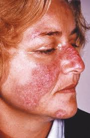 Was hilft bei lupus erythematodes? Was Ist Eigentlich Ein Lupus Erythematodes