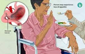 Other similar signs and symptoms of stomach cancer and stomach ulcers include weight loss and anemia. Stomach Cancer Symptoms Causes Treatment Medicine Prevention Diagnosis